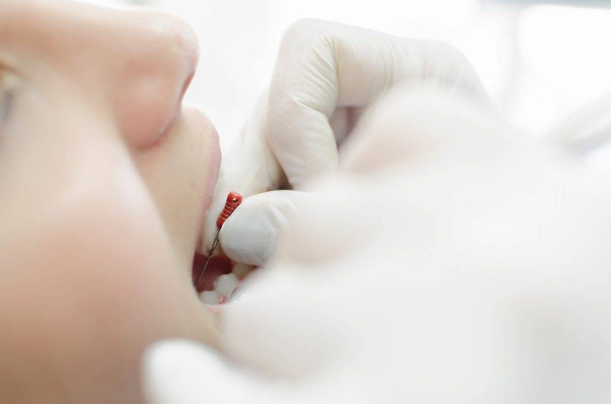 Teeth devitalization at dentist